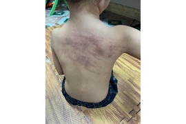 Hải Phòng: Kết luận vụ việc cháu bé nghi bị bạo hành tại trường mầm non An Dương