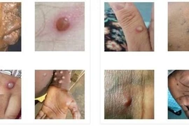 4 giai đoạn từ nhẹ đến nặng của bệnh đậu mùa khỉ 