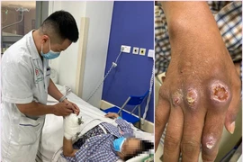 Hoại tử, teo cơ vì tiêm thuốc giảm đau vào khớp