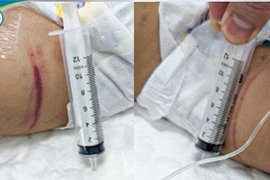 Sức khỏe hiện tại của bé gái 18 tháng tuổi nghi bị bạo hành tại Hà Nội 