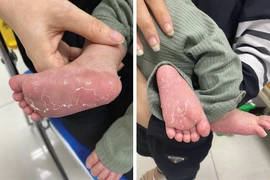 Bé 46 ngày tuổi bị giang mai 