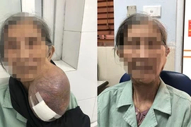 Cắt bỏ khối u 3 kg treo bên má bệnh nhân 85 tuổi 