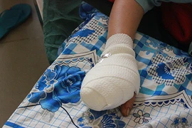 Một phụ nữ bị máy xay thịt nghiền nát bốn ngón tay