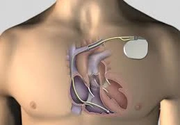 Bệnh nhi năm ngày tuổi được đặt máy tạo nhịp tim vĩnh viễn