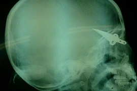 Hội chẩn từ xa cứu cháu bé bị dao găm vào não