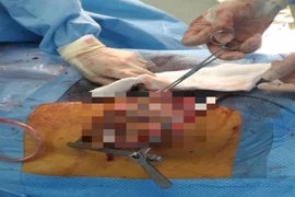 Cắt bỏ khối u gần 7 kg trong lồng ngực bệnh nhân