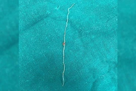 Tìm thấy giun 12 cm từ má của người phụ nữ bị muỗi đốt