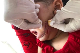Cà Mau: Chó dại tấn công gây thương tích nặng cho bé 19 tháng tuổi