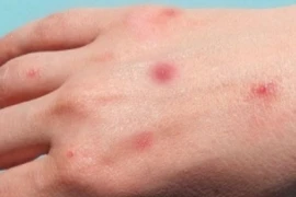 Chủ tịch tỉnh Cà Mau chỉ đạo hoả tốc phòng chống bệnh đậu mùa khỉ