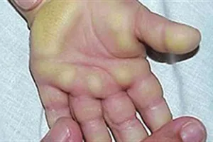 Tái xuất hội chứng viêm da dày sừng tay chân