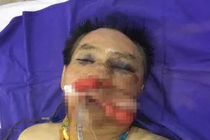 Nguyên đại tá công an đánh anh ruột thương tích nặng