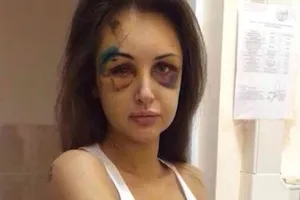 Siêu mẫu Nga biến dạng mặt vì bị người yêu đánh 