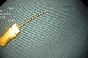 Bé trai 4 tuổi nguy kịch vì nuốt phải cây kim dài 3,5cm 