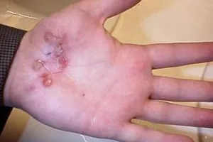 Vi khuẩn ăn thịt người tiến hóa cực nhanh