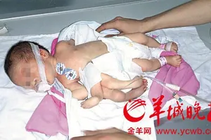 Em bé 8 chân tay ở Trung Quốc