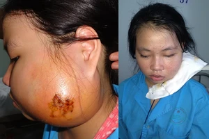 Cắt bỏ thành công khối u gây biến dạng khuôn mặt bé gái