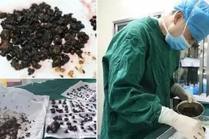 Kinh hoàng phát hiện 200 viên sỏi trong cơ thể
