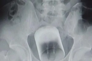 Bác sĩ đau đầu ca bệnh ly nước kẹt trong ... hậu môn