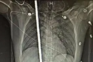 Sống sót kì diệu dù bị thanh sắt 2m đâm xuyên người