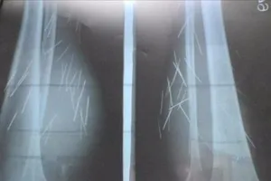 70 cây đinh tự trồi ra khỏi chân 1 phụ nữ