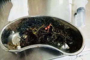Phát hoảng vì bệnh nhân có 1 kg gỗ, nhựa trong người