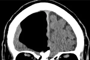  Bác sĩ sốc với người đàn ông 'thất lạc' 1/4 bộ não 