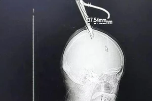 Bị kéo đâm xuyên đầu vẫn tỉnh bơ đi bus đến bệnh viện