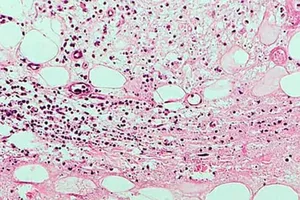 Úc đau đầu với đại dịch “loét ăn thịt” ngày một lan rộng