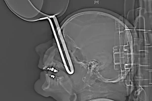 Say xỉn nấu ăn, người đàn ông bị cán chảo cắm vào mắt