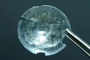 Tìm thấy kính áp tròng thất lạc trong mí mắt sau 28 năm