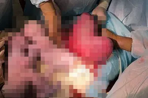 Kỳ diệu mẹ sinh đôi với tử cung hình trái tim