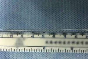 Phát hiện sán dài 10cm, sống khỏe trong não bệnh nhân