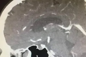 Khối u não bỗng dưng biến mất kỳ lạ trước ngày phẫu thuật