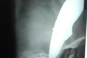 Bị dao đâm xuyên đầu vẫn đạp xe đến bệnh viện