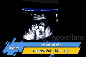 Buồn cười xem thai nhi song sinh “oánh nhau” trong bụng mẹ