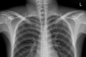 Nhậu xỉn, chàng trai nuốt luôn chìa khóa nhà