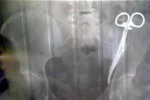 Hoảng hồn phát hiện bác sĩ để quên kẹp trong bụng suốt 23 năm