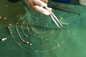 Kỳ lạ bé 7 tuổi có 526 chiếc răng