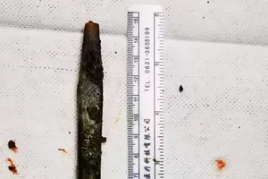 Bàn chải mắc kẹt trong ống mật suốt 20 năm