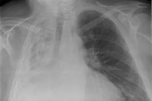 Tràn khí màng phổi sau khi thi hát karaoke