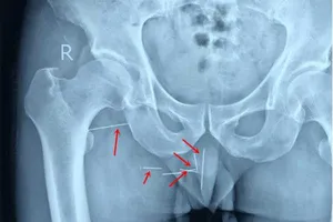 Bị 8 cây kim găm vào mông 10 năm mà không hề hay biết