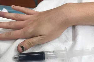 Kỳ lạ máu một phụ nữ bỗng chuyển thành màu xanh