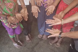 Gia đình 12 người đều có 12 ngón tay, 14 ngón chân