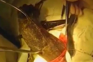 Phát hiện khối tóc nặng 1,8 kg bên trong dạ dày bệnh nhân