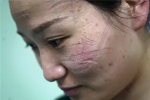 Vết khẩu trang hằn trên mặt một y tá đang chống dịch tại Vũ Hán. Ảnh: CHINA DAILY