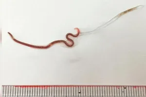 Con giun được lấy ra khỏi amidan cô gái. Ảnh: CNN