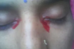 Kỳ lạ cô gái khóc ra máu mỗi tháng một lần