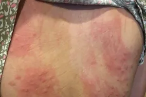 Đà Nẵng: Lấy mẫu nước, truy nguyên nhân gây ngứa sau tắm biển