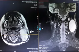 Khối u nằm ở vị trí nguy hiểm