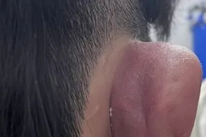 Nhiễm trùng, hoại tử vành tai do xỏ khuyên tai